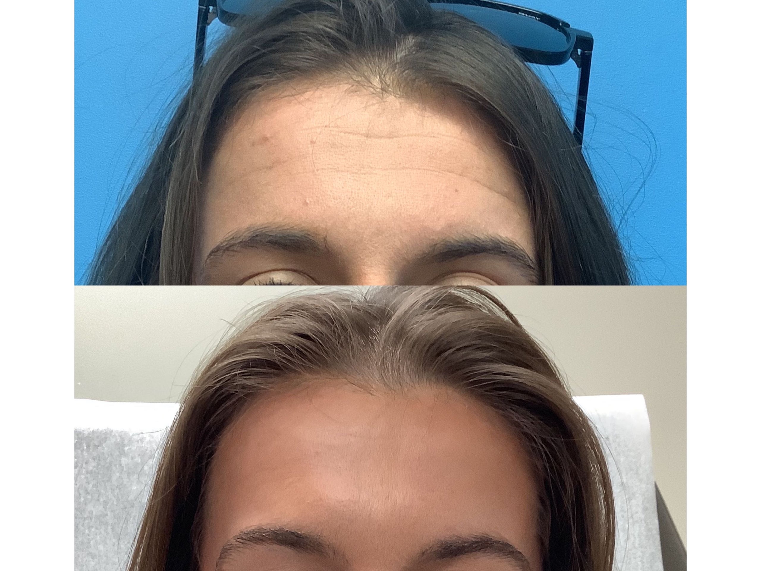 Smoothed forehead after neuromodulator treatment