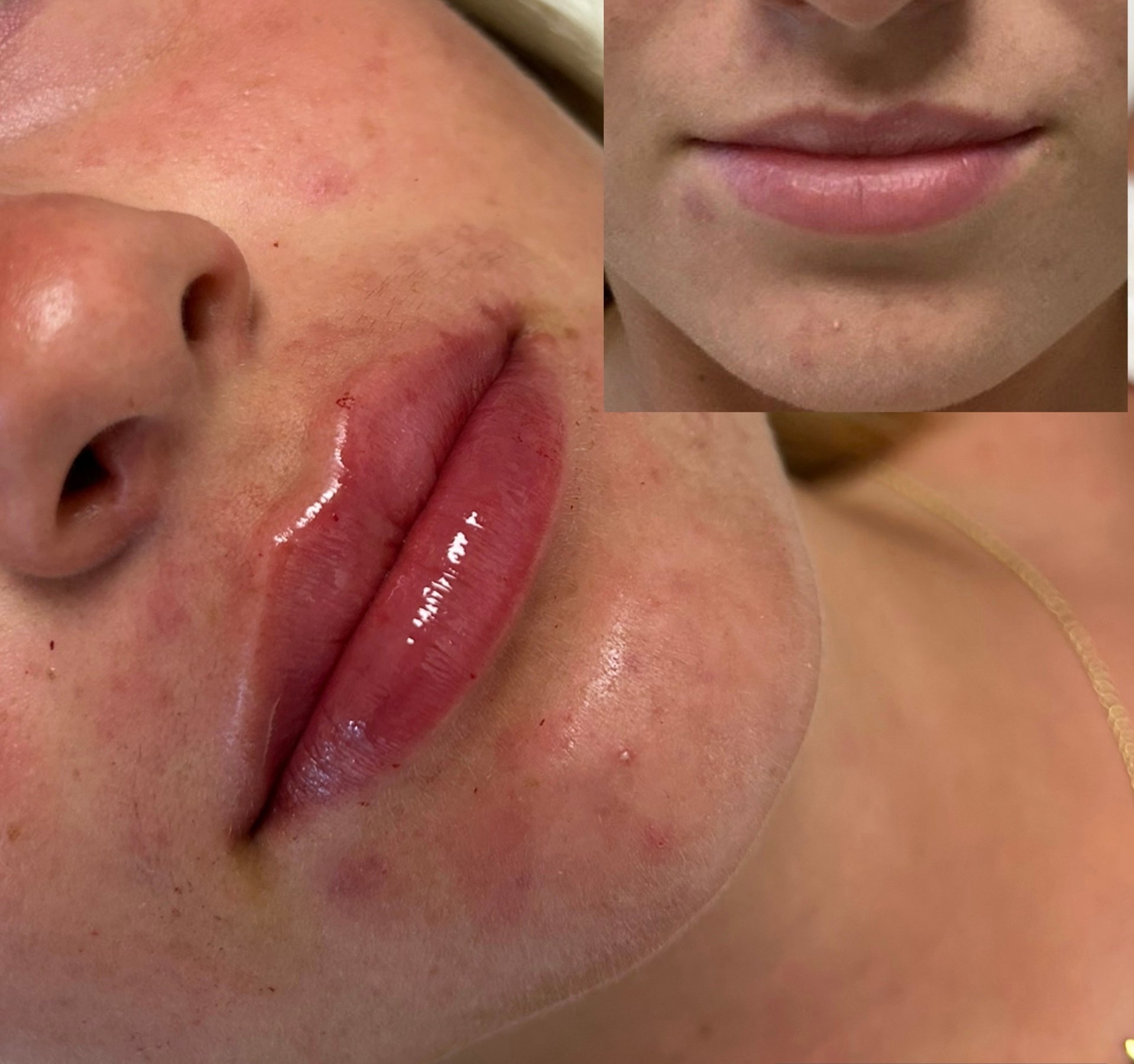 Natural-looking lip enhancement results