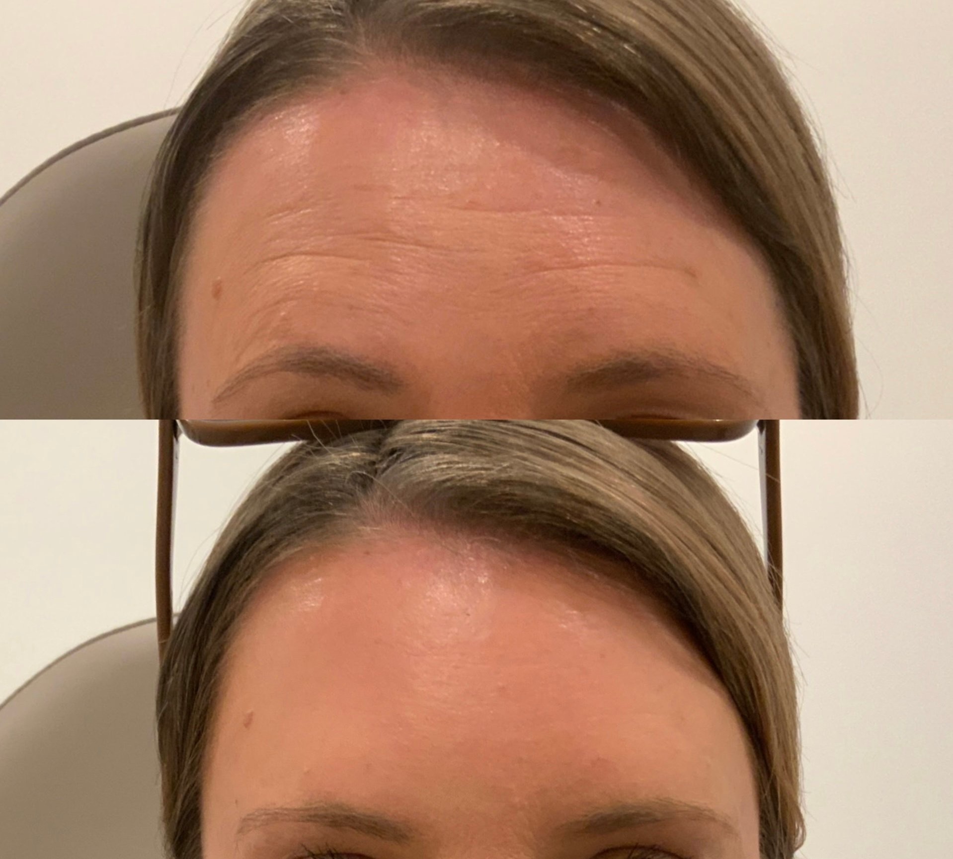 Refreshed, natural facial results after treatment
