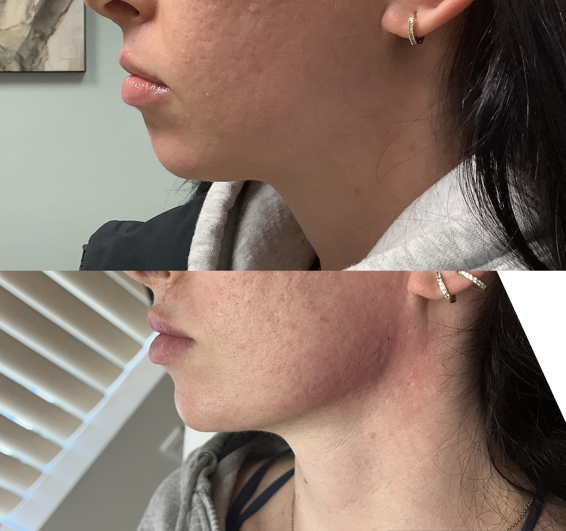 Defined jawline and chin after filler